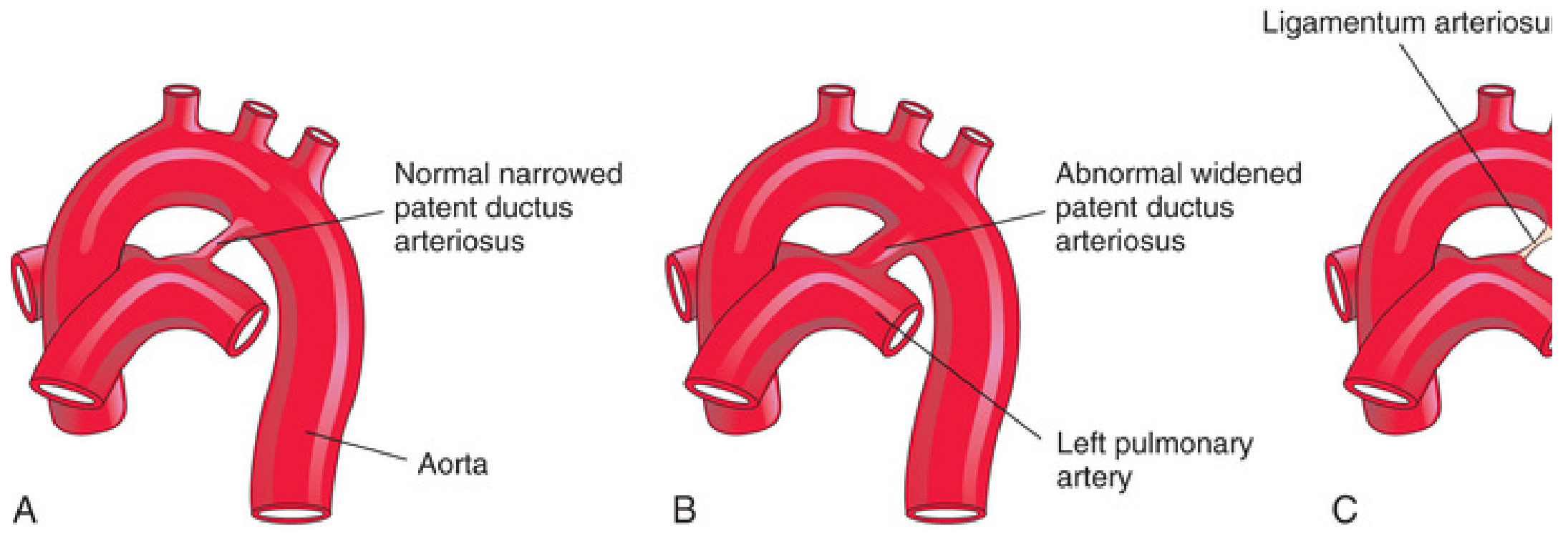 Normal and patent ductus arteriosus