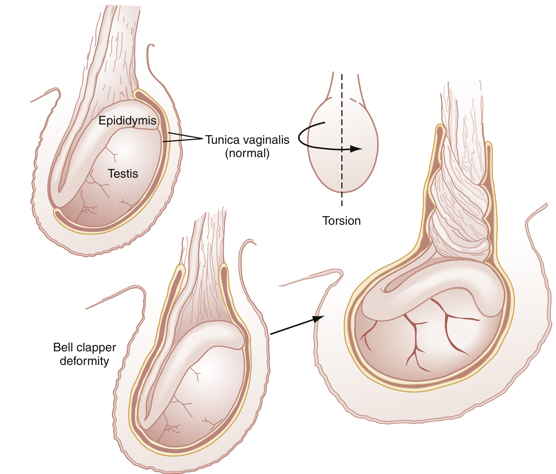 Bell clapper deformity and testicular torsion anatomy