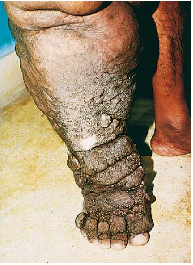 Massive edema and elephantiasis caused by filariasis - Robbins Pathology
