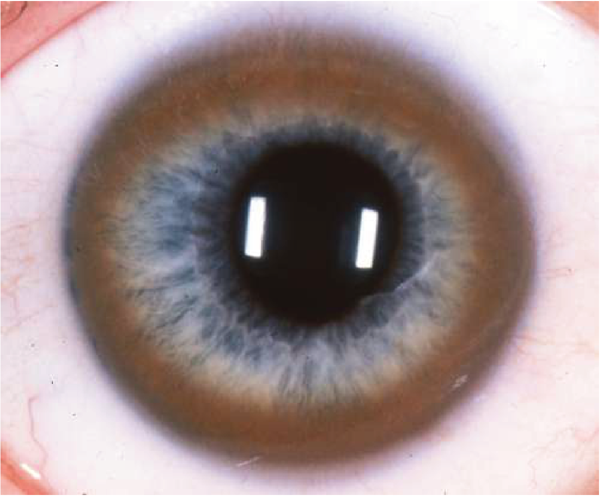 Kayser-Fleischer ring — brown ring visible at the corneal periphery