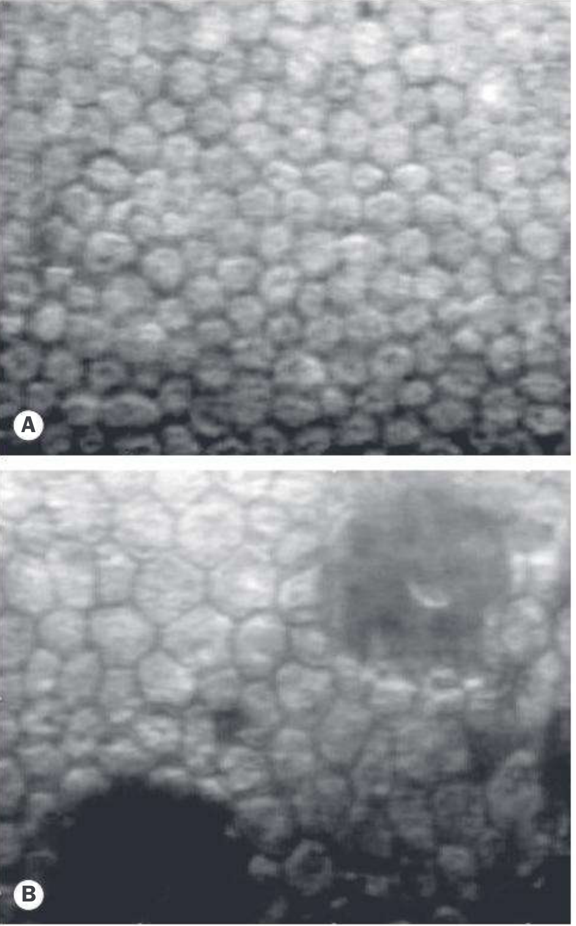 Specular micrograph: (A) Normal corneal endothelium showing uniform, densely packed hexagonal cells. (B) Cornea guttata showing marked loss of the regular endothelial mosaic and larger, irregular remaining cells.
