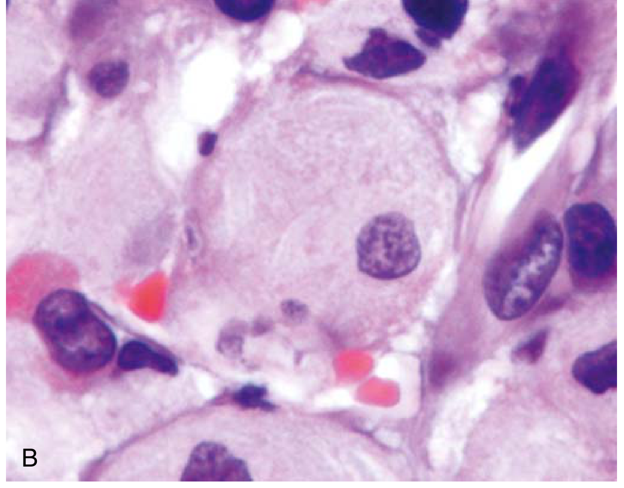 Gaucher cell (H&E stain) - bone marrow showing characteristic pale cytoplasmic texture