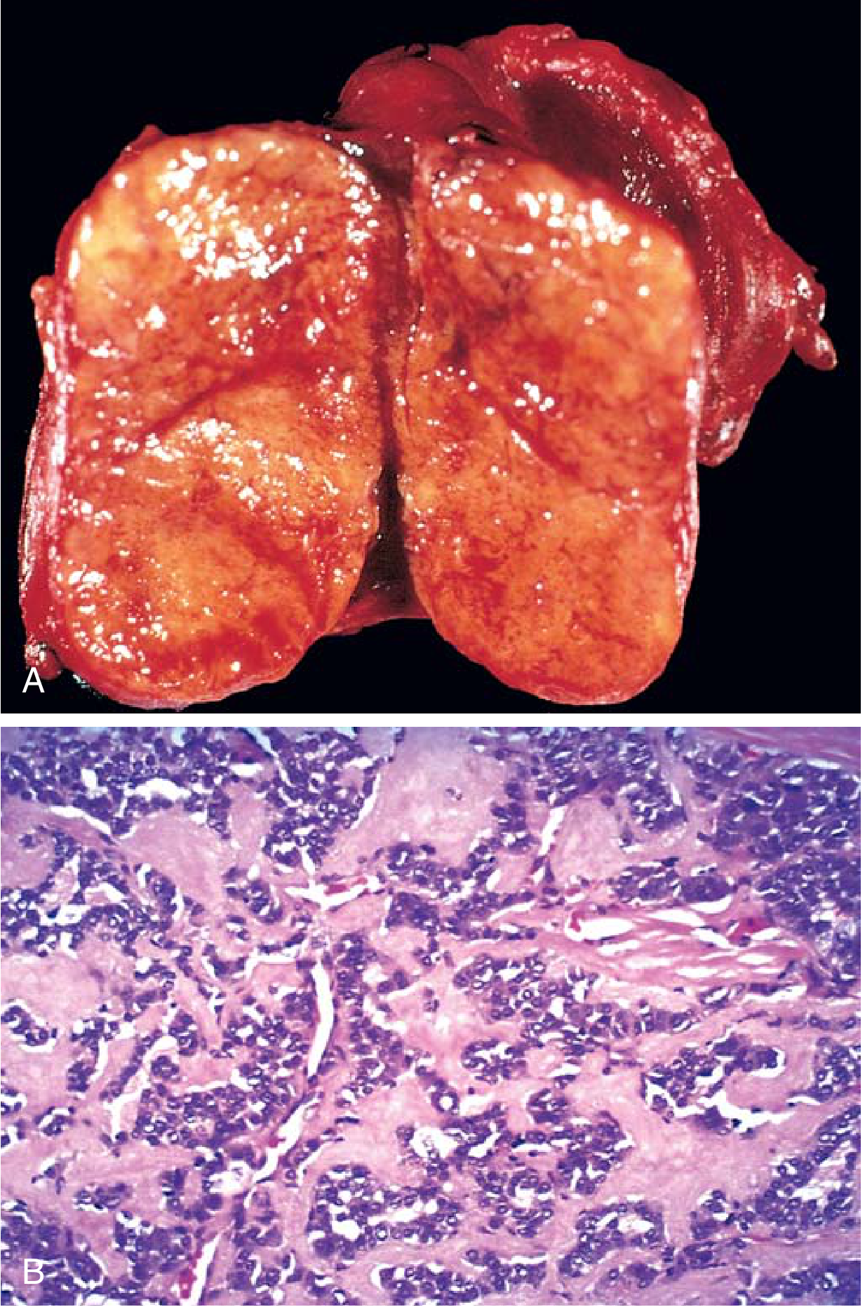 MTC gross and microscopic pathology — (A) bisected solid mass without fibrous capsule; (B) abundant homogeneous pink stromal amyloid