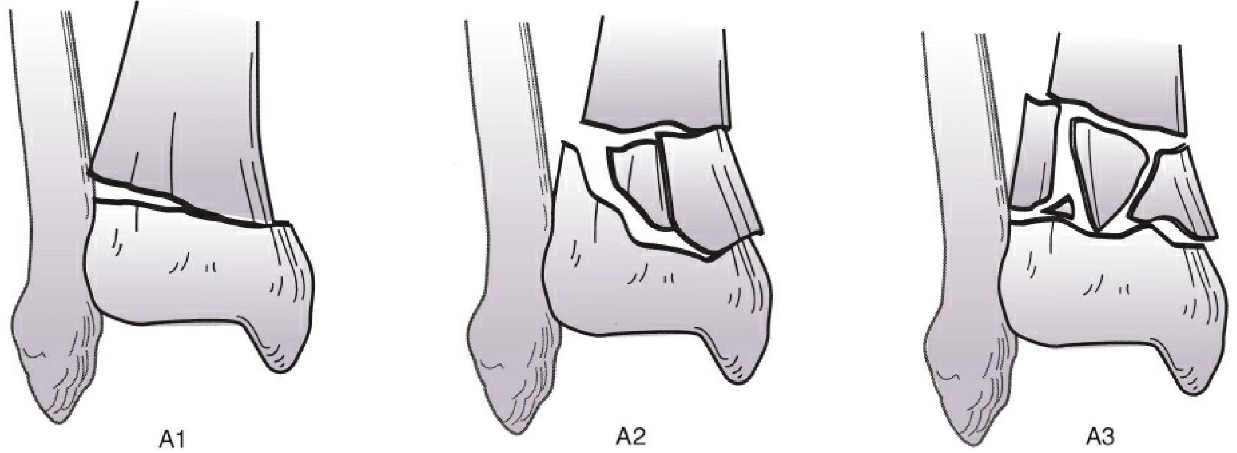 AO/OTA Type A (Extra-articular) pilon fractures - A1, A2, A3