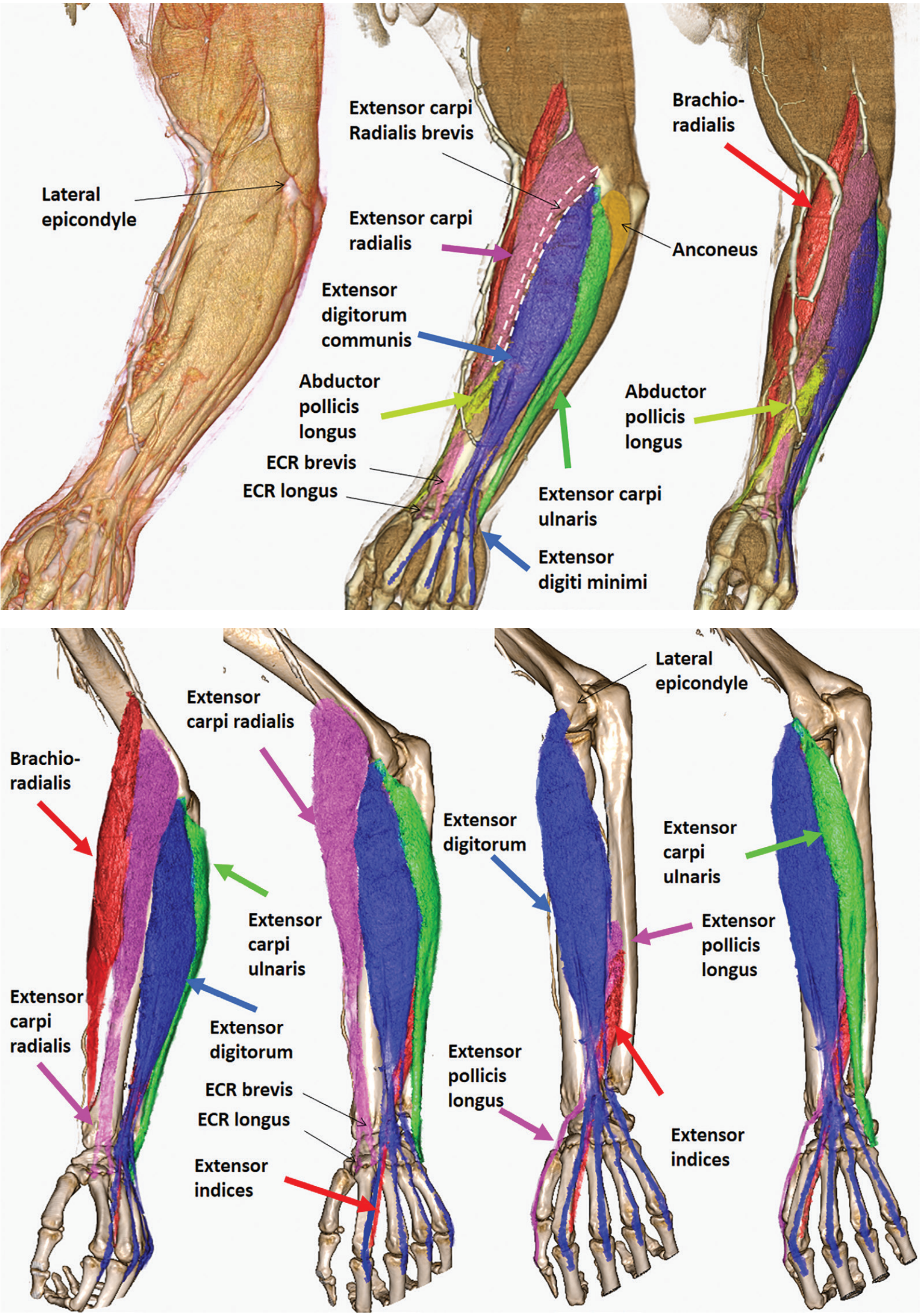 Lateral forearm musculature - brachioradialis is the most radial/lateral muscle (red arrow)