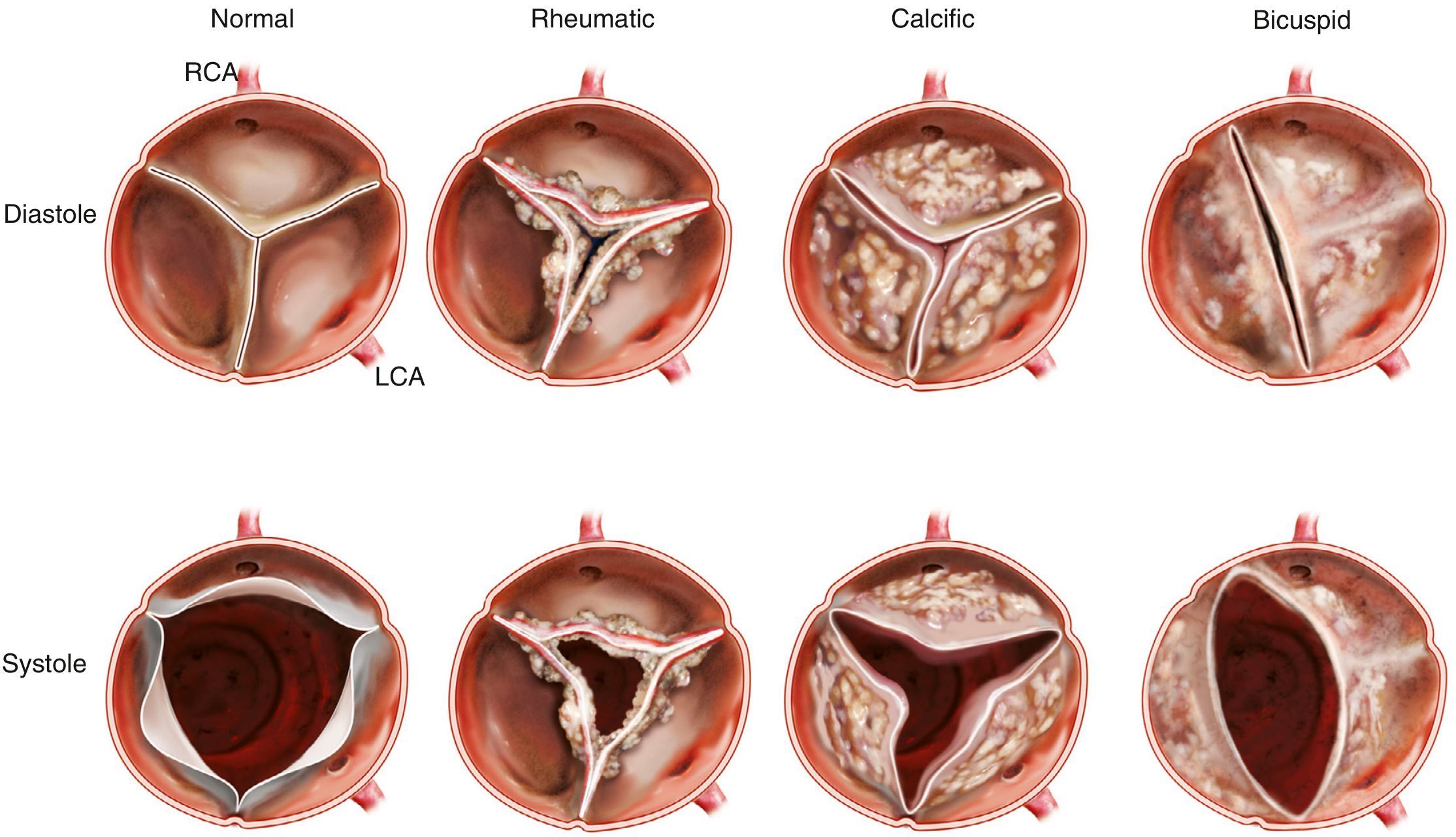 Causes of aortic stenosis - echocardiographic view showing normal, rheumatic, calcific, and bicuspid aortic valve appearances in diastole (top) and systole (bottom)