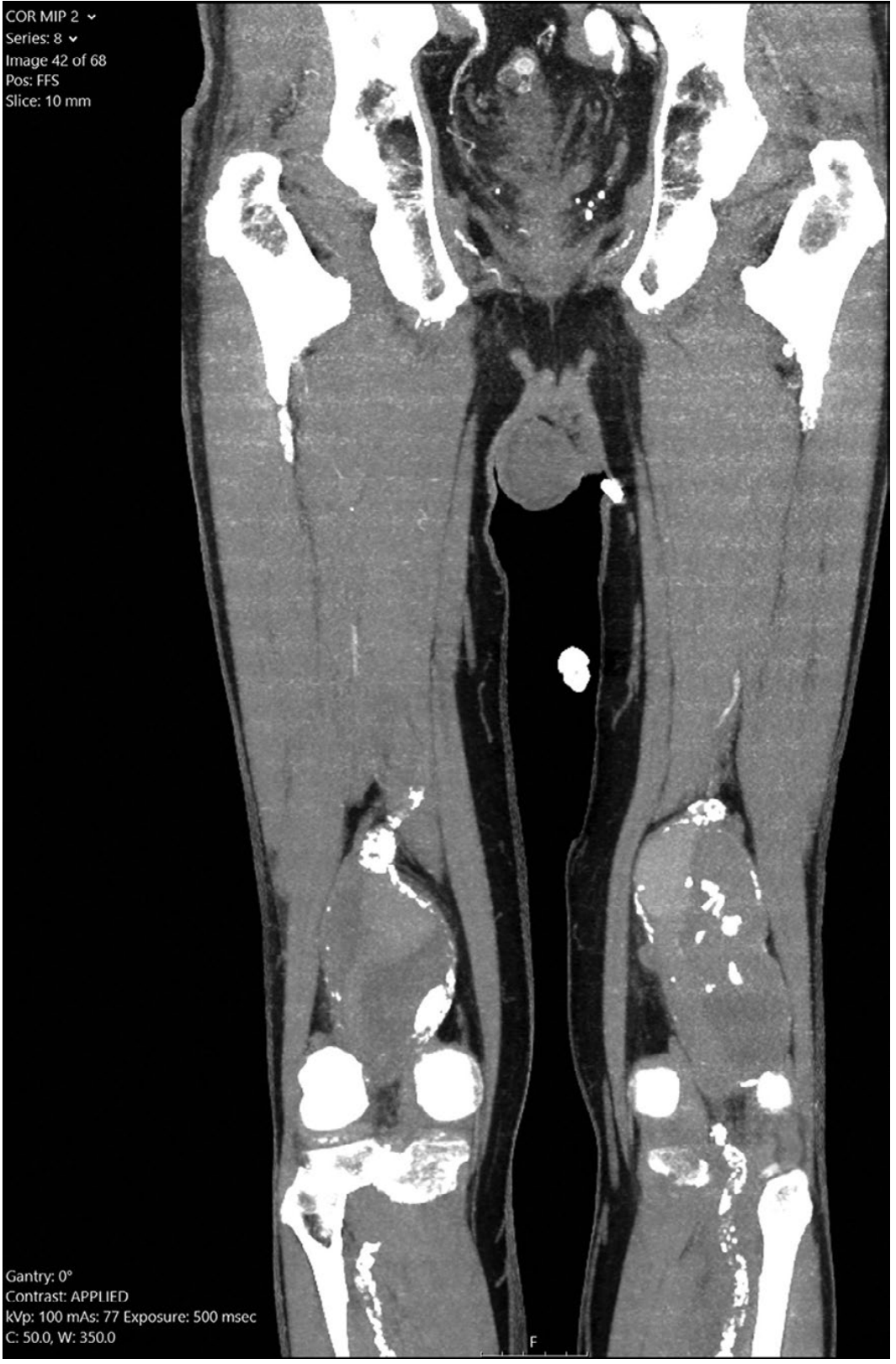 Bilateral PAA on CT coronal MIP reconstruction