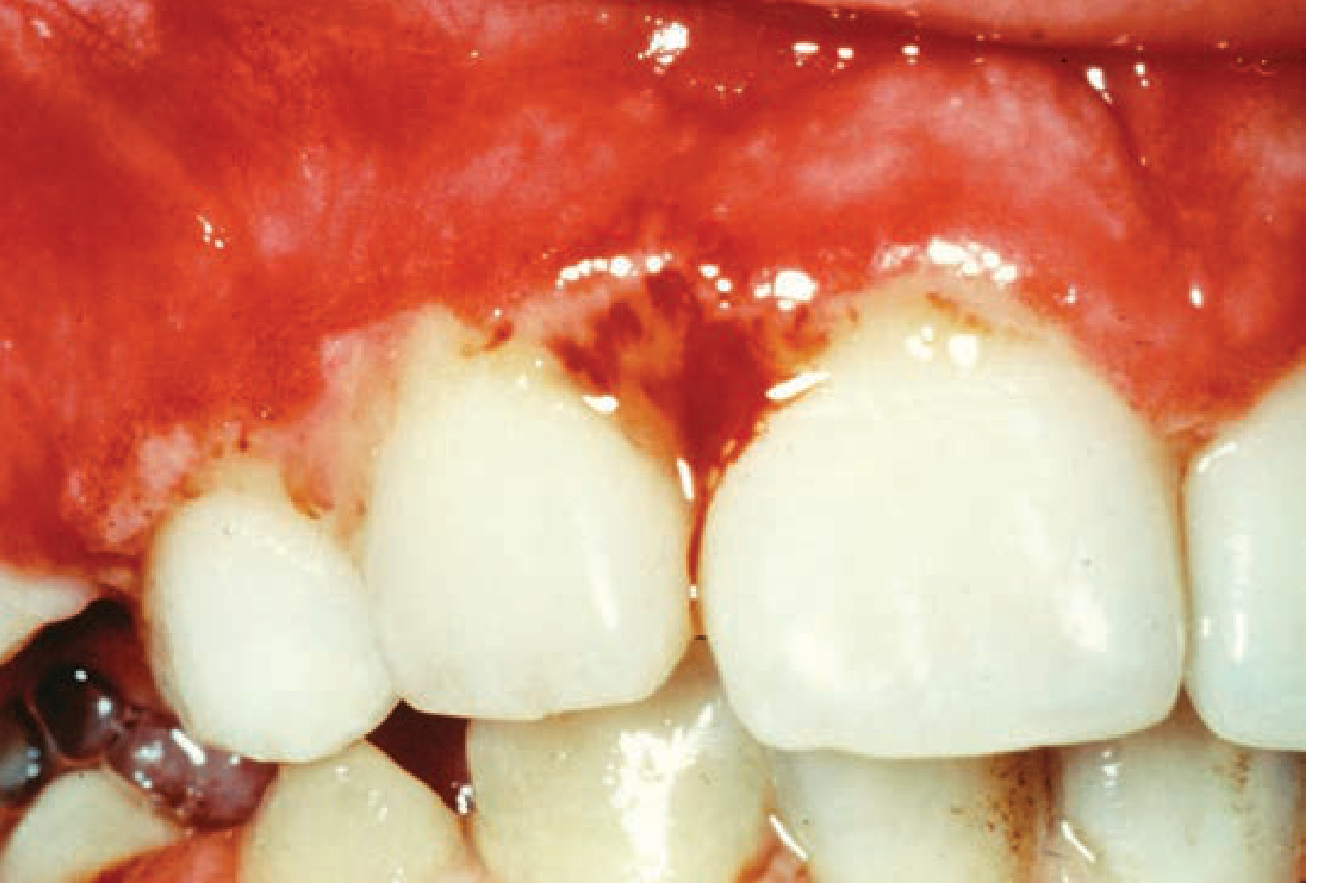 Acute necrotizing ulcerative gingivitis - severely inflamed, bleeding gums with ulceration