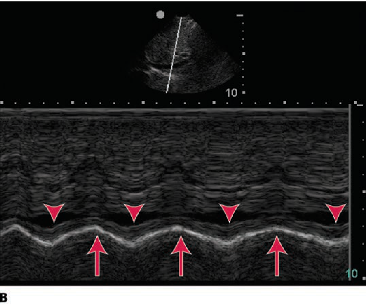 IVC collapsed - prerenal AKI