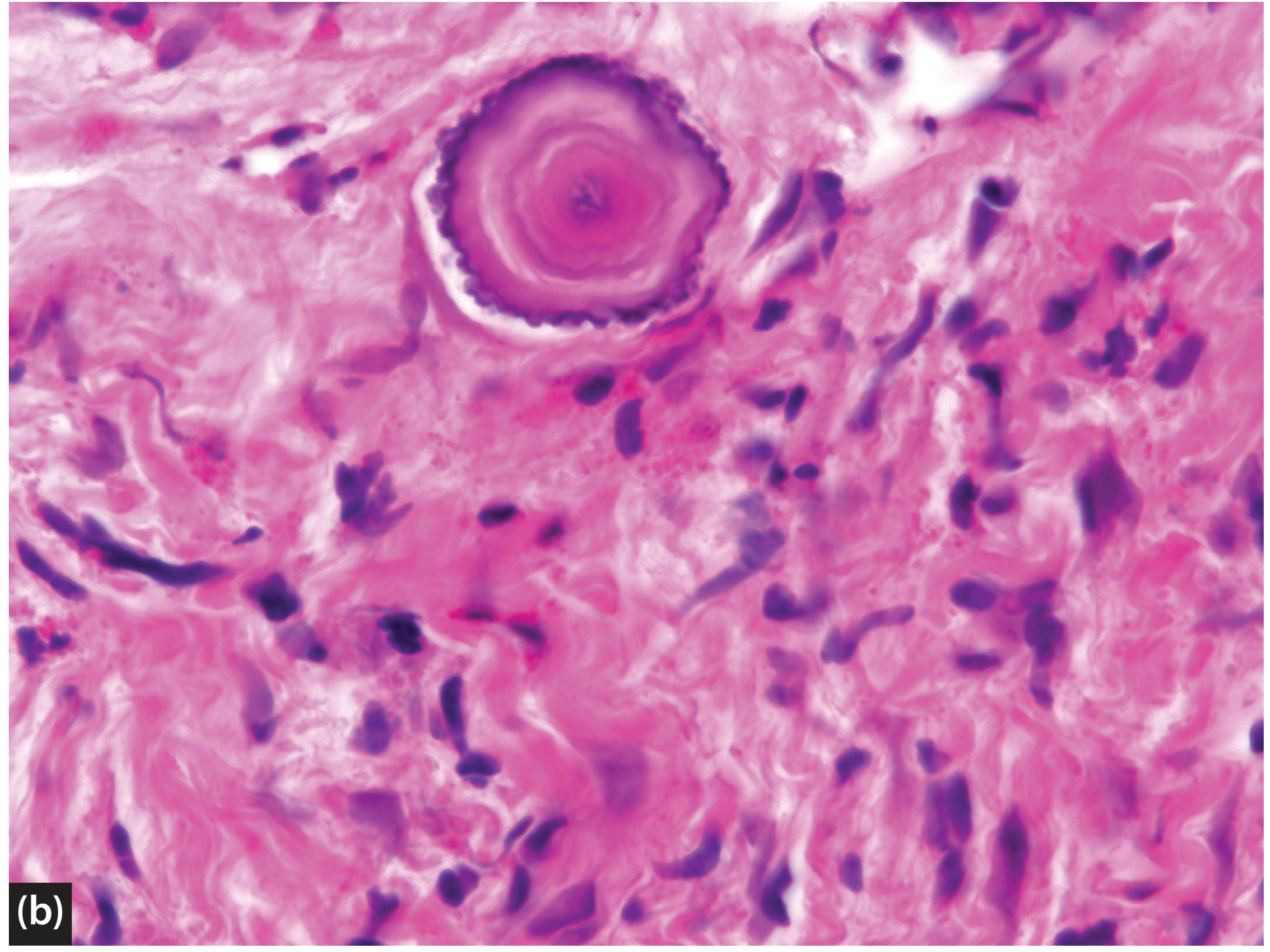 Psammoma body in papillary thyroid carcinoma - concentrically laminated calcification that is virtually pathognomonic