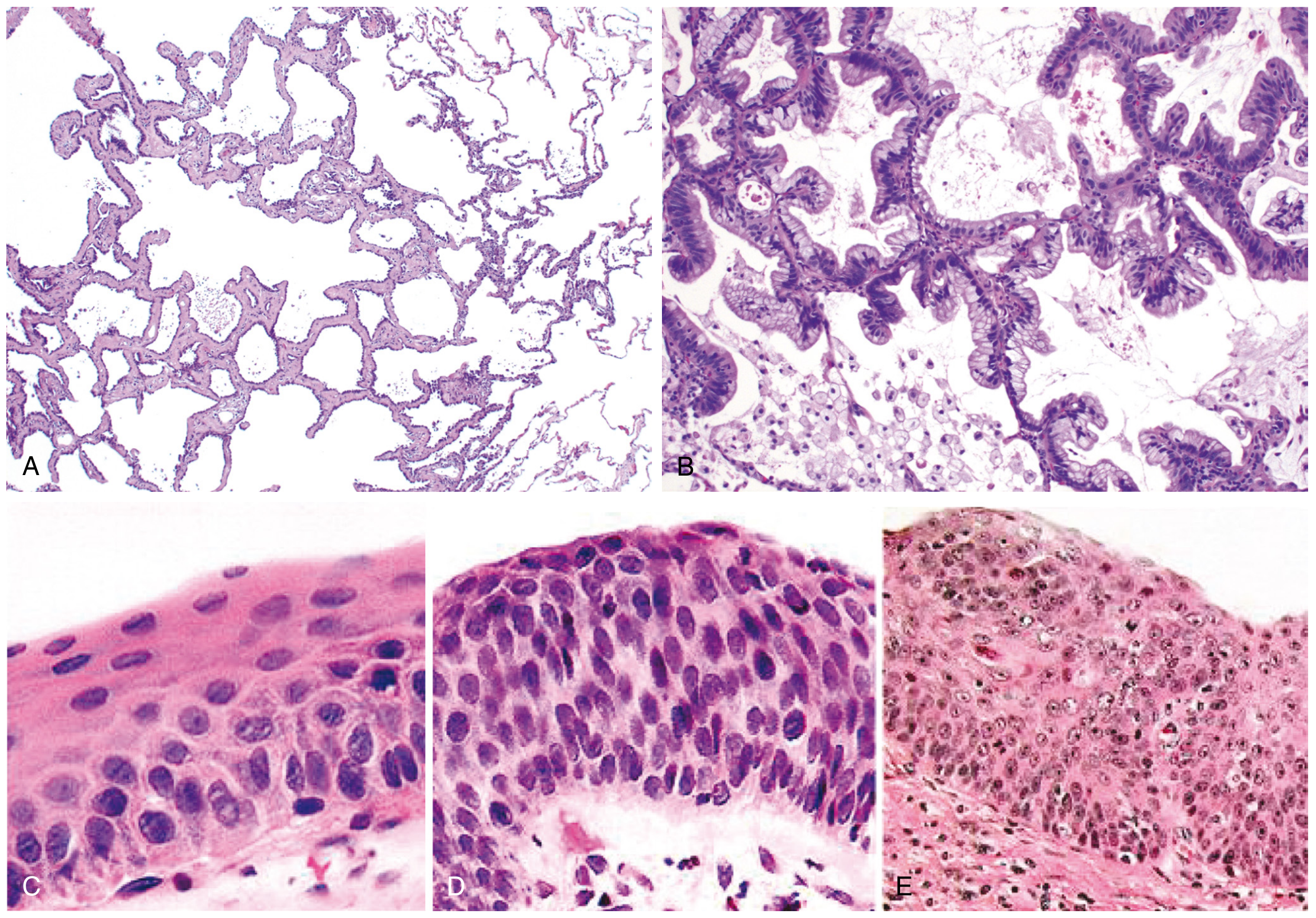 Precursor Lesions of Lung Cancer
