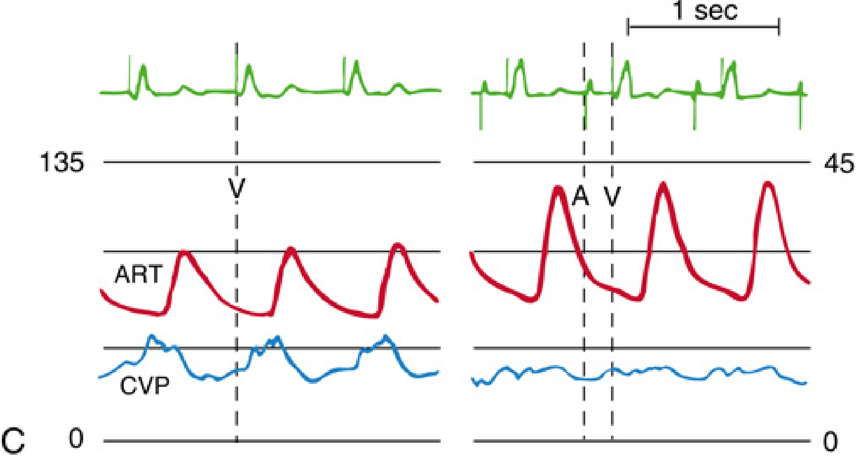 CVP and ART waveforms during VT and paced rhythm showing dissociation
