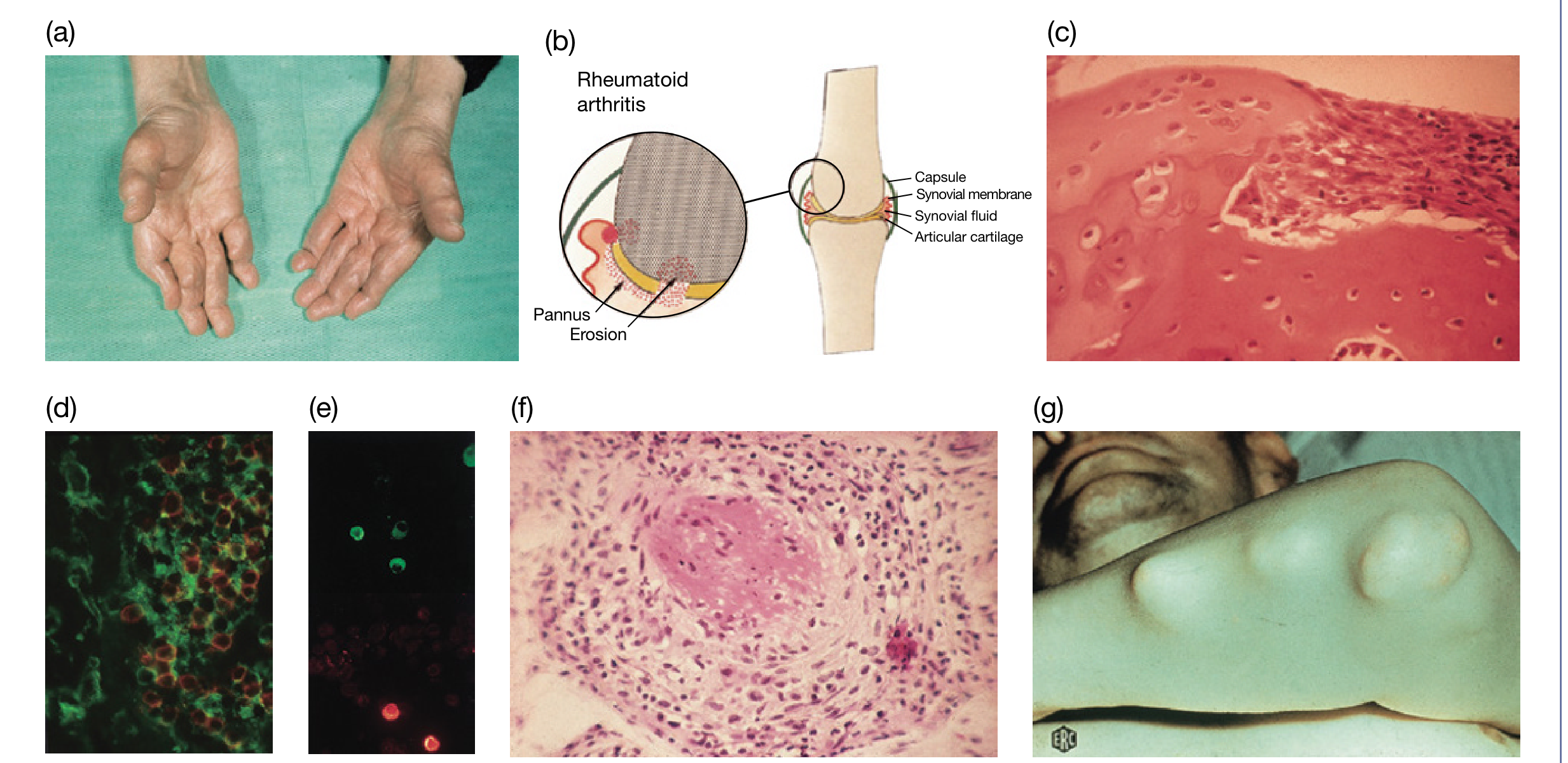 RA overview: hands with deformity, joint diagram showing pannus/erosion, histology of nodule, and subcutaneous nodule
