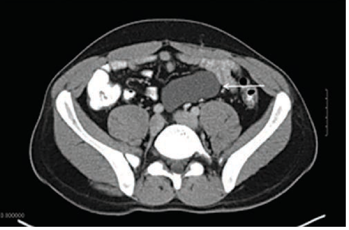 Mesenteric cyst CT scan
