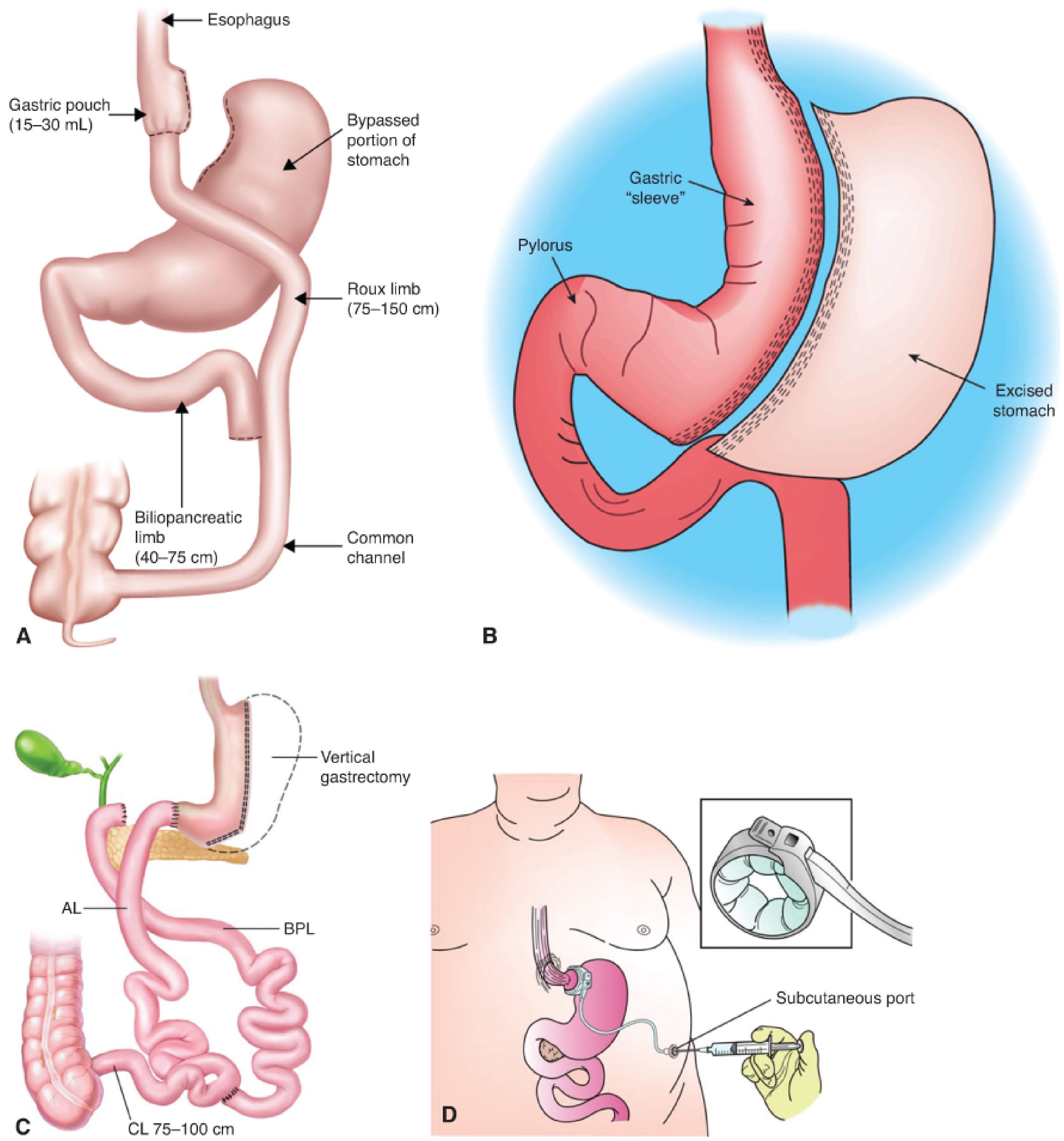Roux-en-Y Gastric Bypass and bariatric procedures