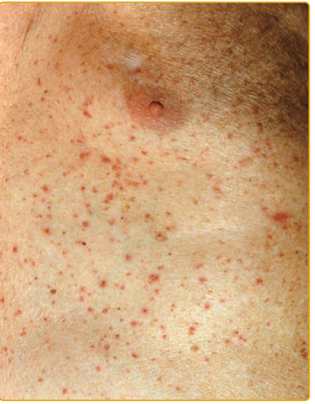 Grover disease - scattered red papules on trunk