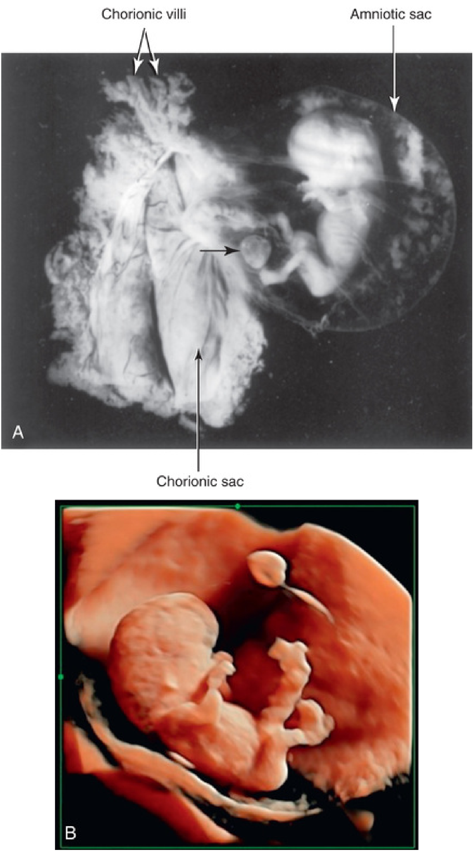 Photograph of 9-week fetus inside amniotic sac with chorionic villi visible, and 3D ultrasound of 10-week fetus showing umbilical cord insertion