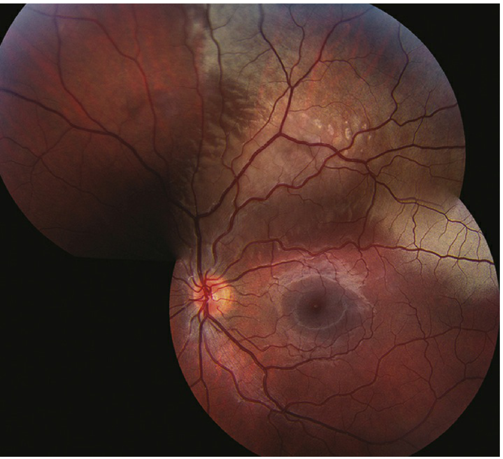 Commotio retinae - Berlin's edema showing confluent retinal whitening around the macula with a dark fovea