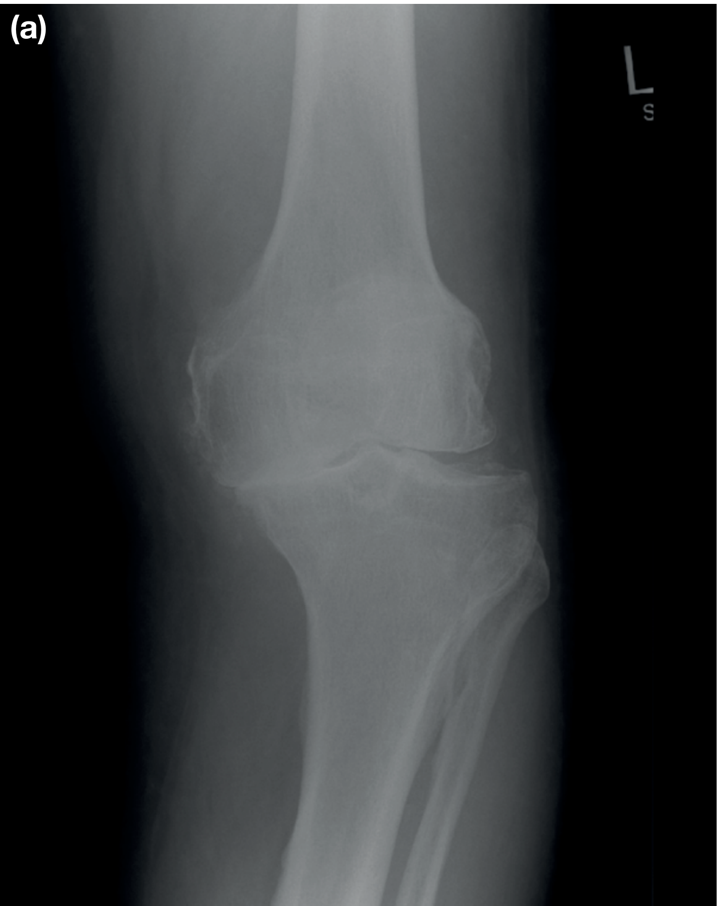 Anteroposterior X-ray of knee OA showing medial joint space narrowing, subchondral sclerosis, and osteophytes
