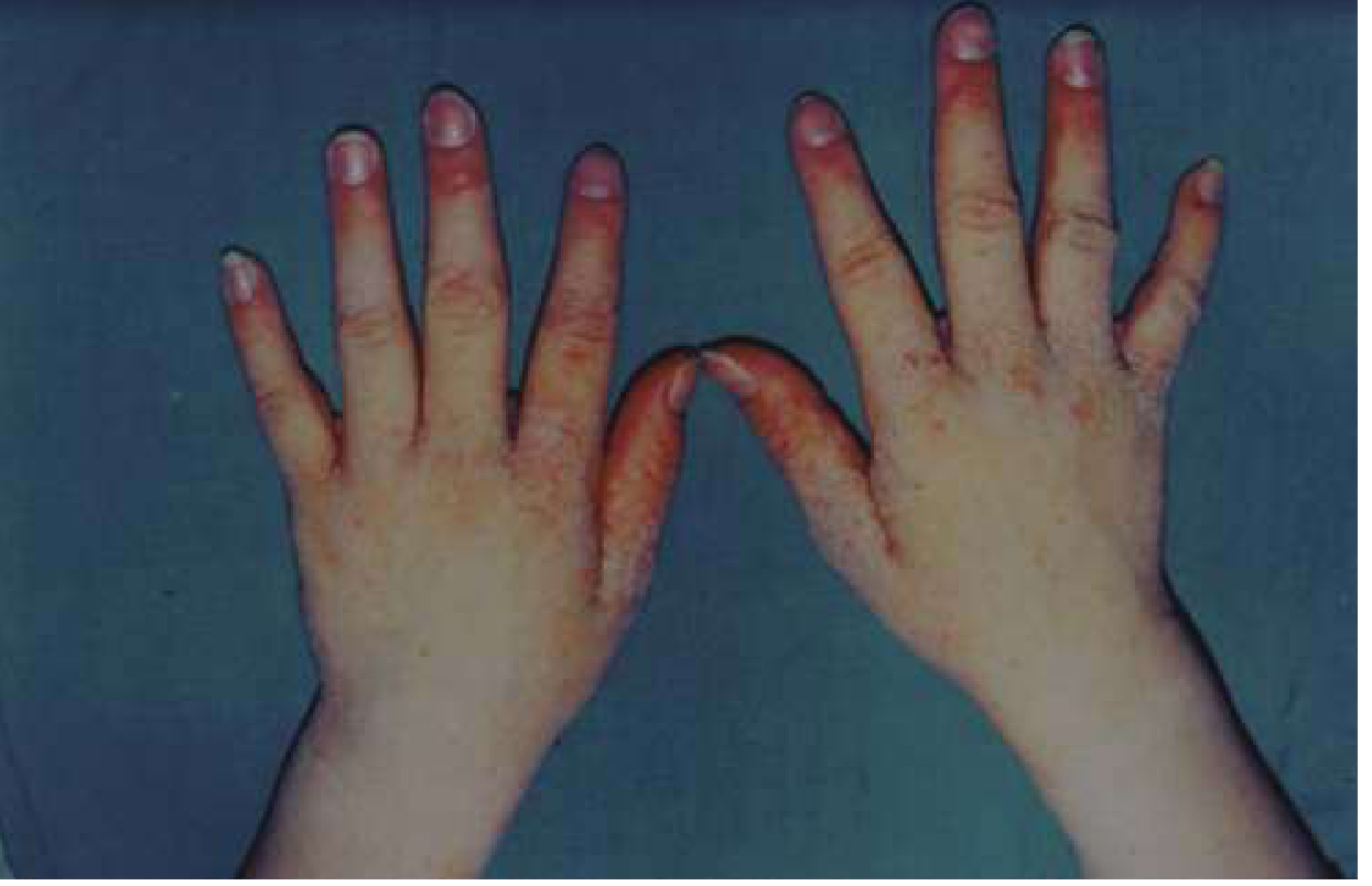 Scabies - small papules on hands