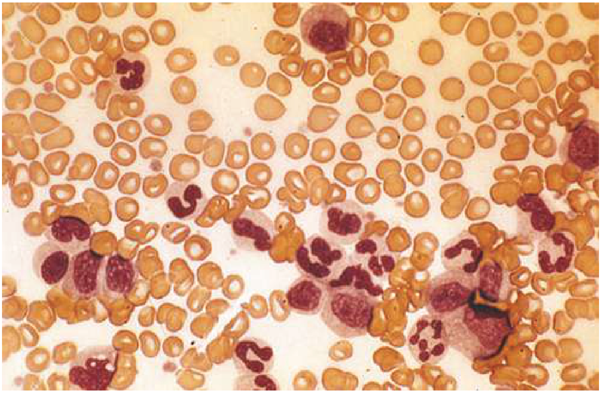 CML chronic phase peripheral smear - leukocytosis with the entire spectrum of leukocyte differentiation from myeloblasts to mature neutrophils