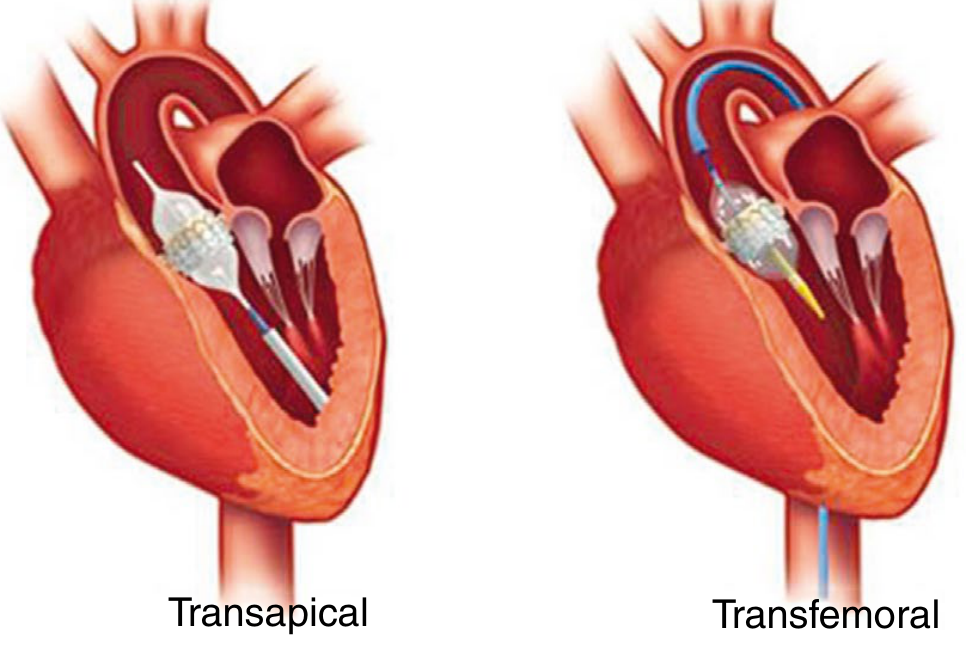 Anatomical cross-section of the heart showing transapical (left) and transfemoral (right) TAVI delivery routes with catheter and valve visible in situ