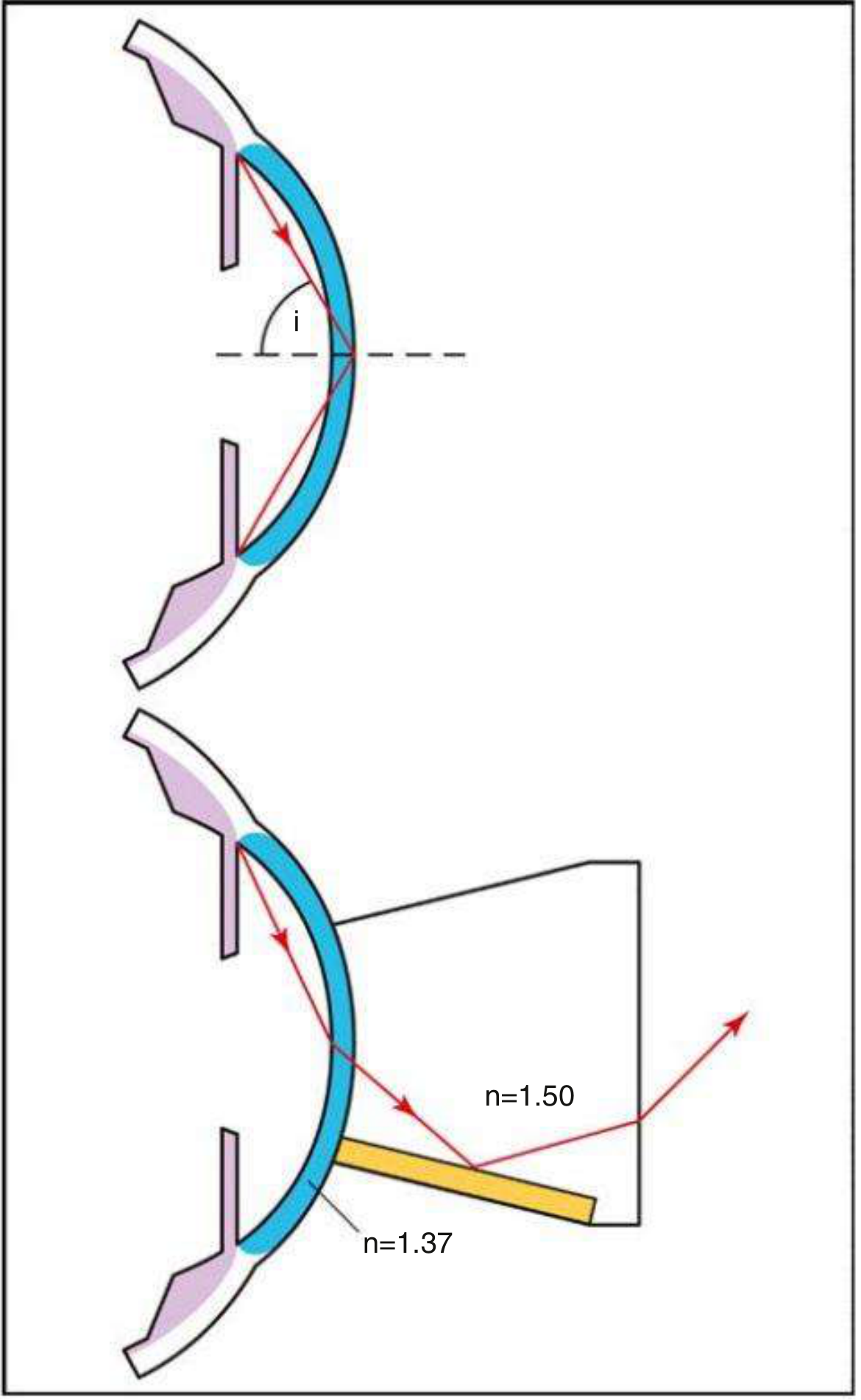 Optical principle diagram showing total internal reflection and how goniolens overcomes it