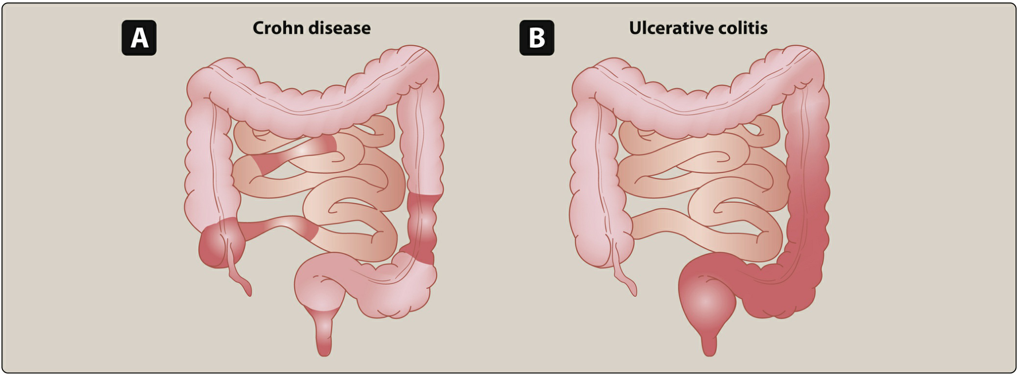 Crohn disease vs Ulcerative colitis — distribution patterns