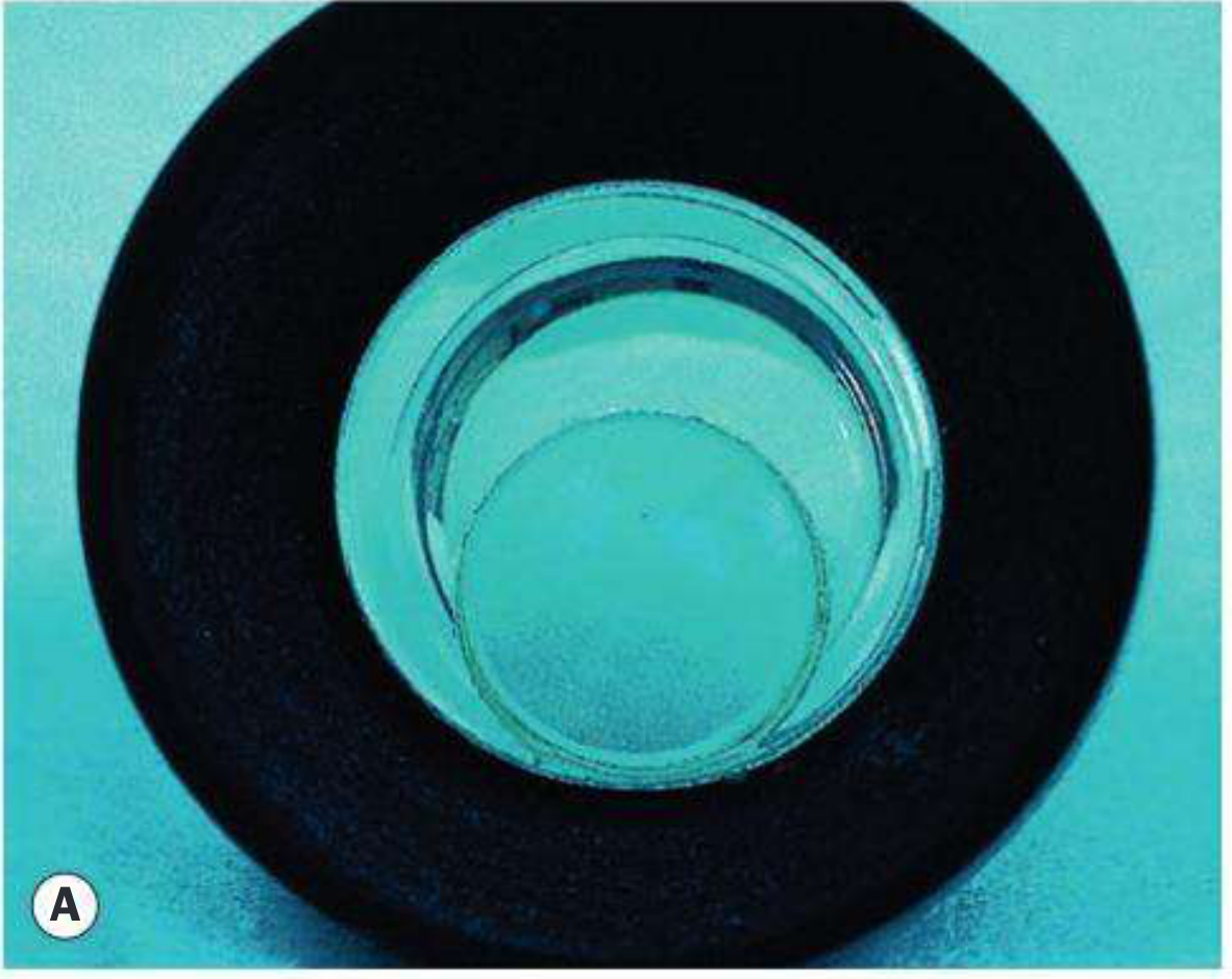 Abraham iridotomy lens
