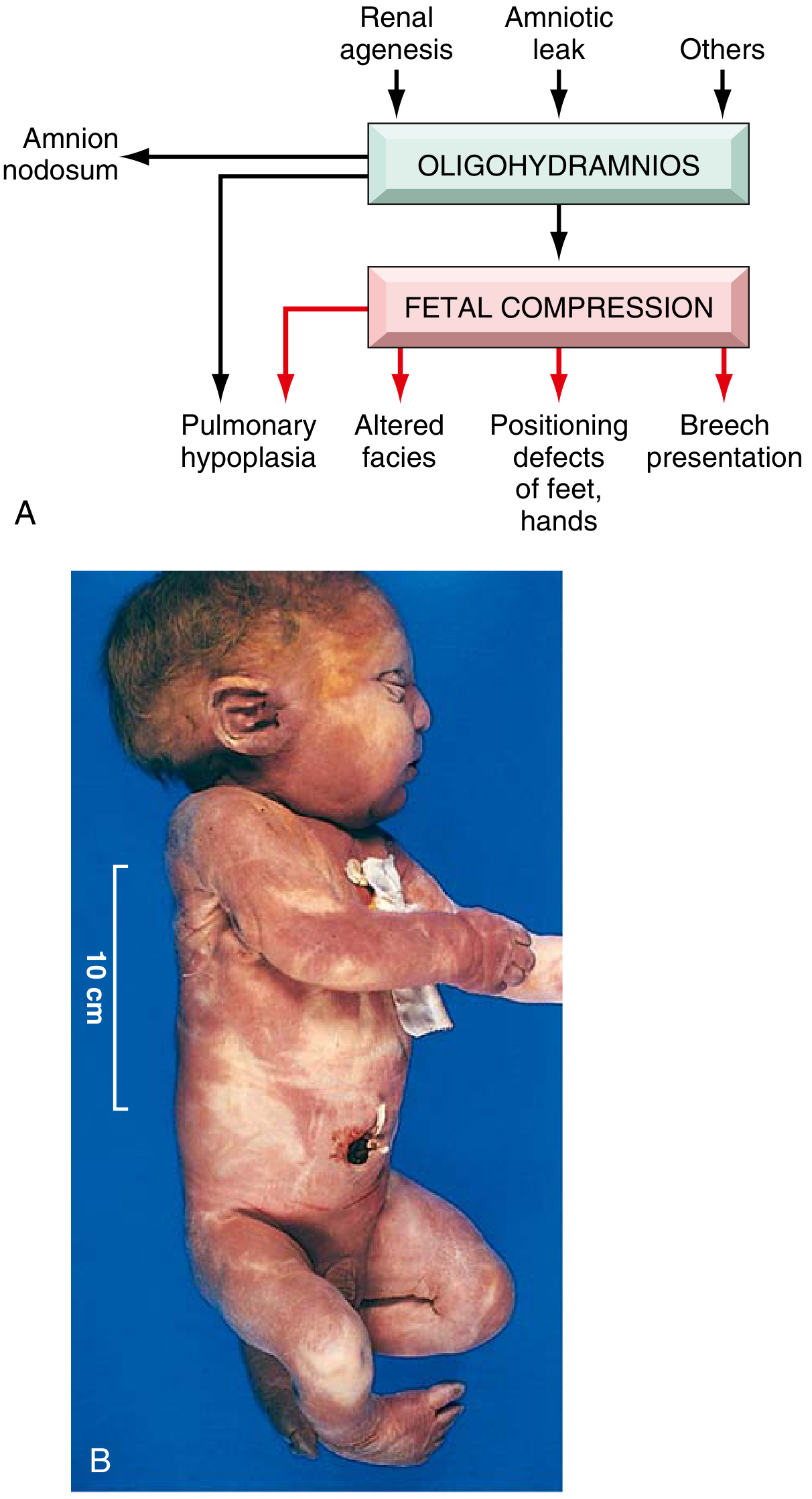 Potter sequence pathogenesis diagram