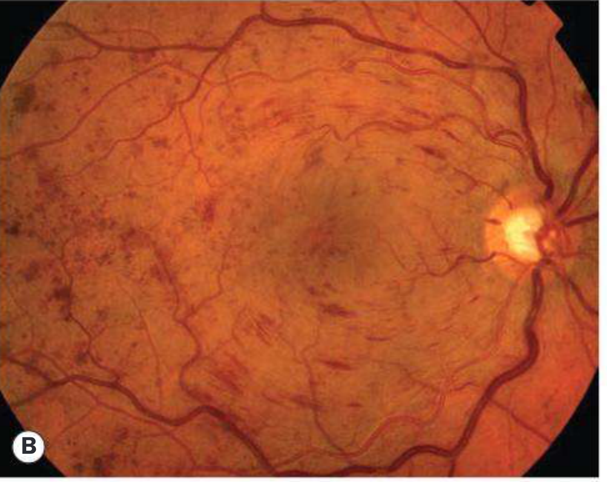 Ischaemic CRVO - severe haemorrhages all quadrants, disc swelling, cotton-wool spots