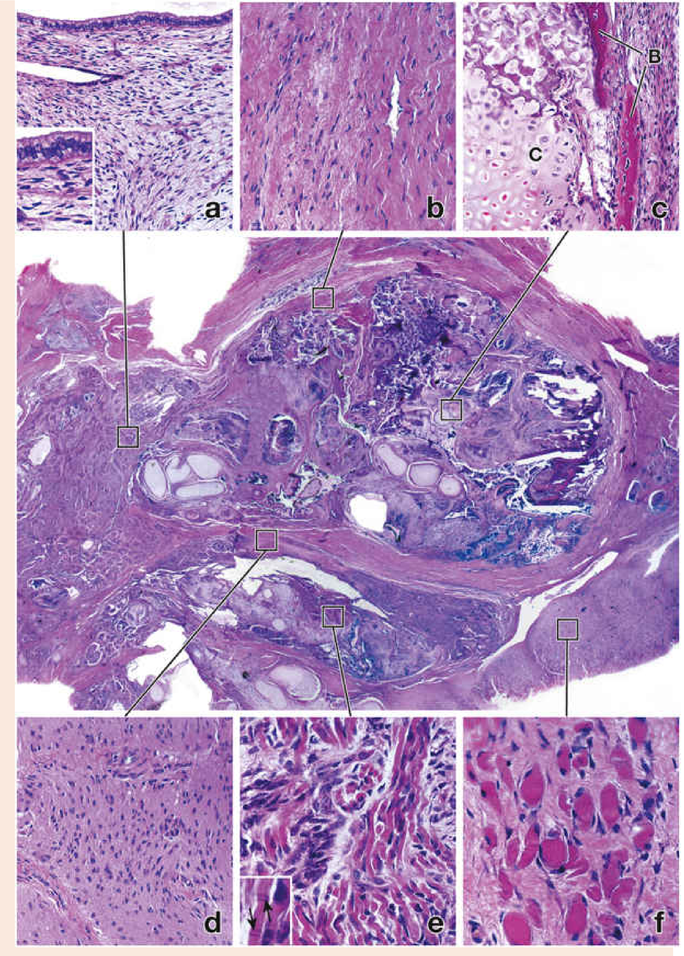Ovarian teratoma H&E histology: center shows disorganized mass; insets show (a) columnar epithelium, (b) dense connective tissue/tendon, (c) hyaline cartilage (c) and bone (B), (d) brain/glial tissue, (e) cardiac muscle with intercalated discs, (f) skeletal muscle cross-sections