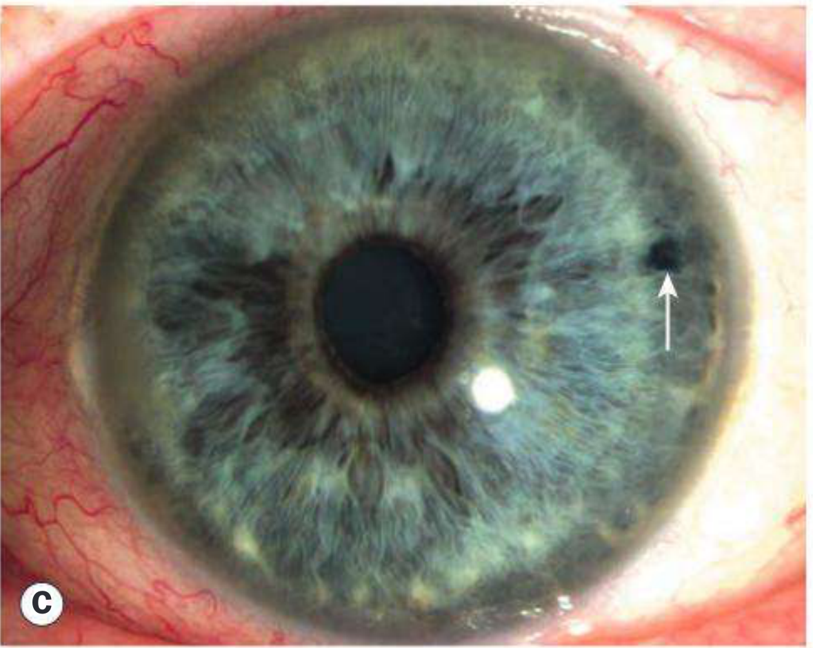 Temporal laser iridotomy