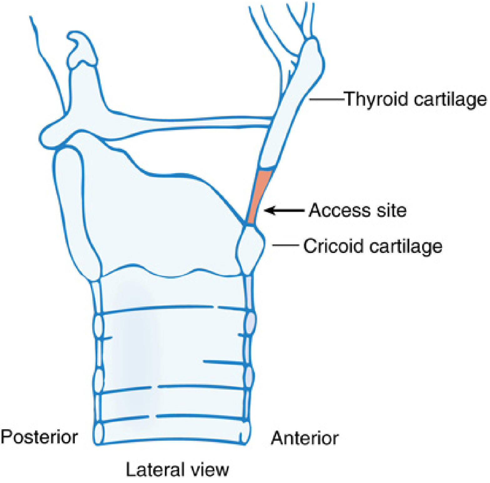 Midsagittal anatomy of larynx and trachea showing CTM access site