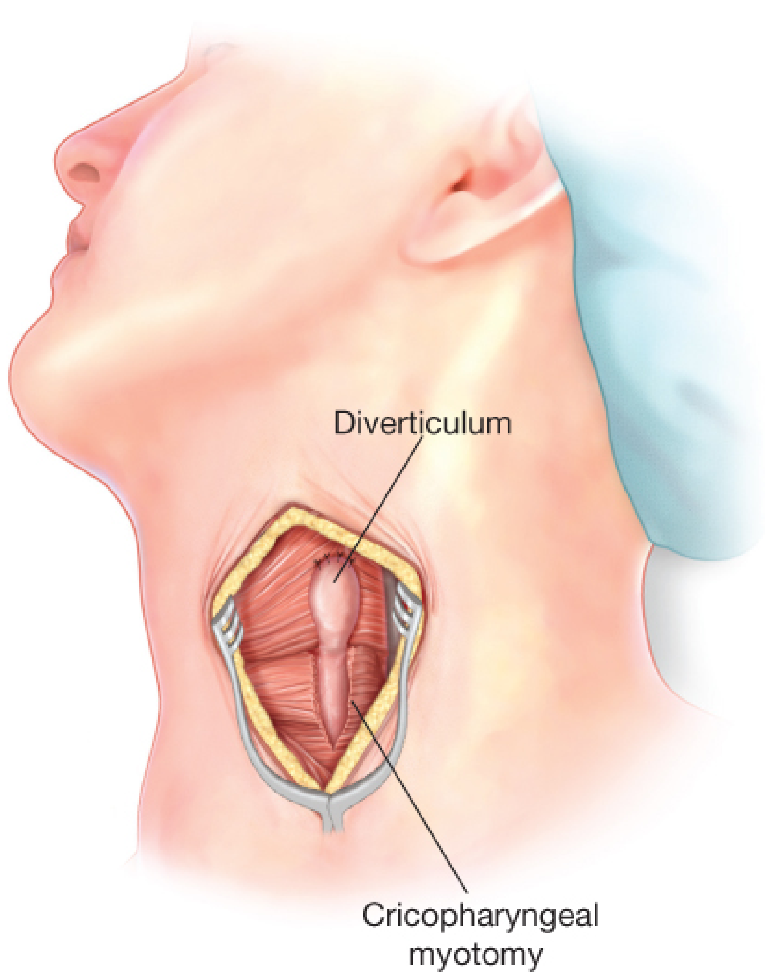 Surgical illustration showing Zenker diverticulum with cricopharyngeal myotomy via left transcervical approach