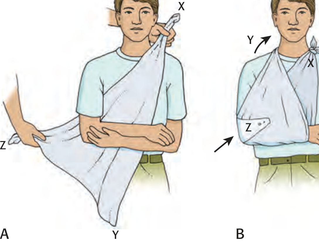 Triangular muslin sling - application steps (A) and completed sling (B)