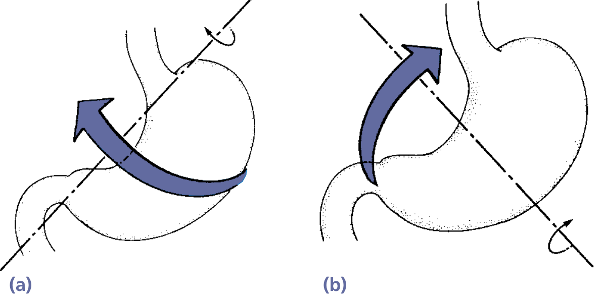 Schematic: (a) organoaxial volvulus - stomach rotates along its long axis; (b) mesenteroaxial volvulus - stomach rotates along its short transverse axis