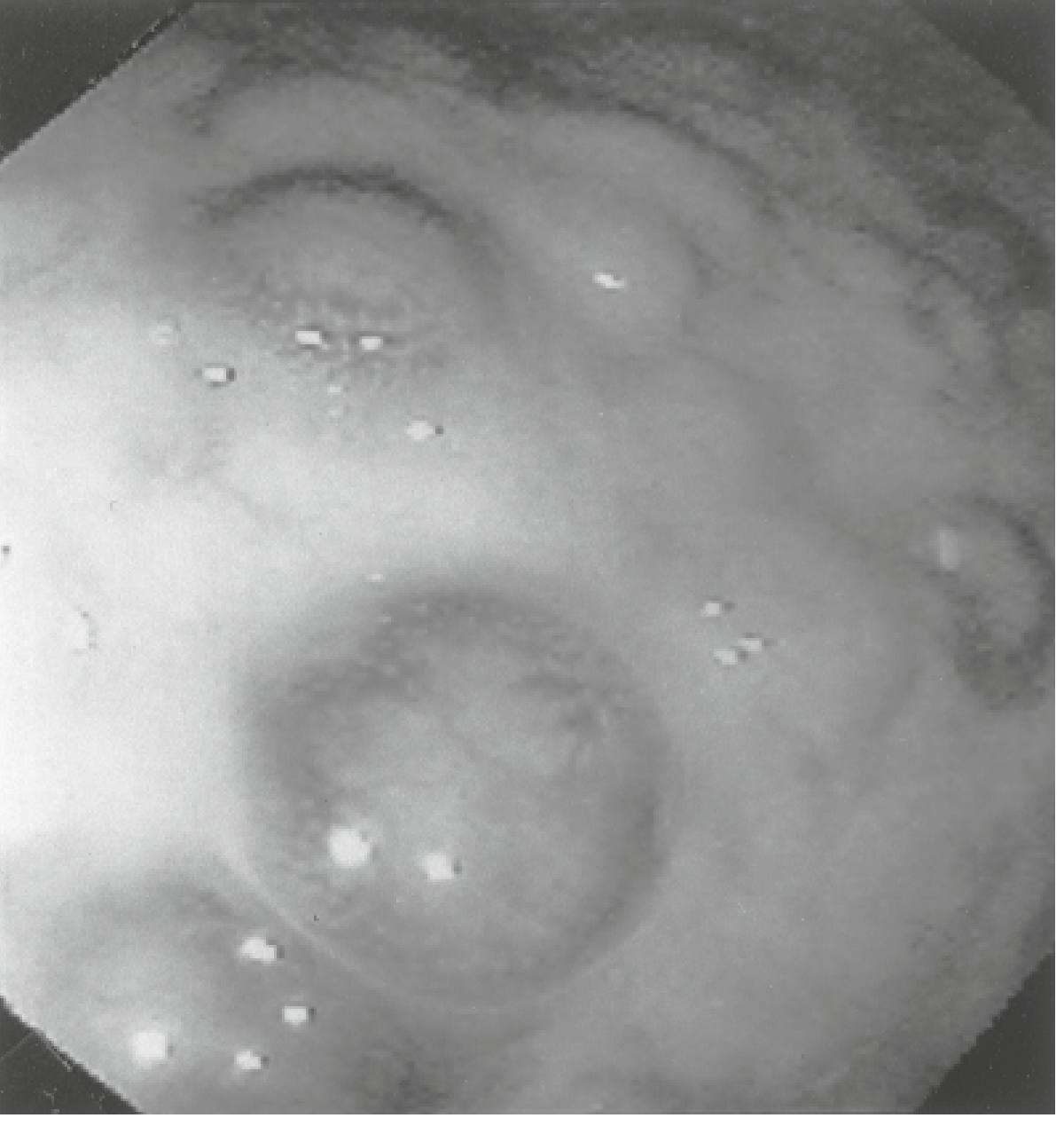 Mantle cell lymphomatous polyposis - endoscopic view of polypoid nodules