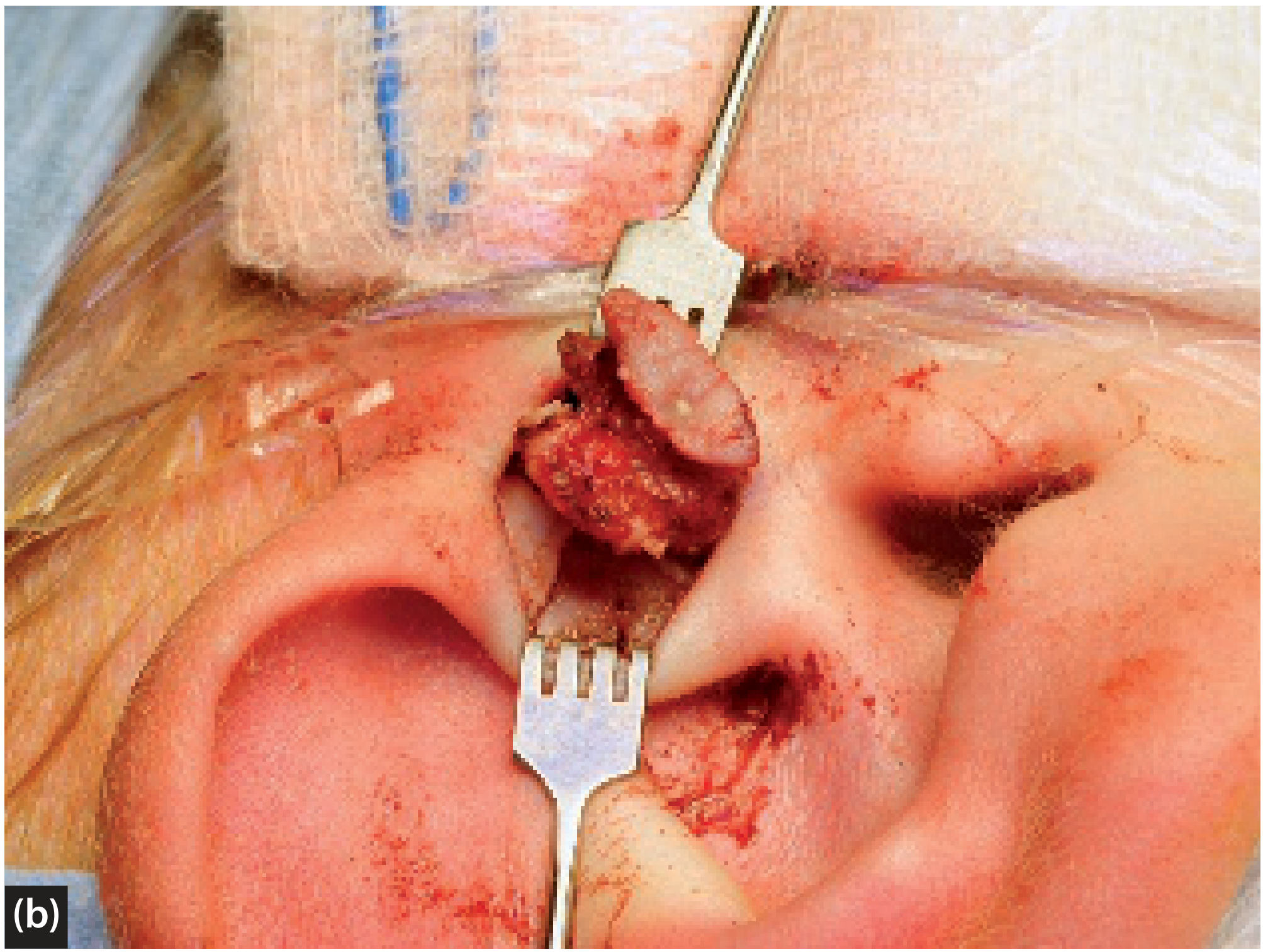 Surgical excision of preauricular sinus - intraoperative