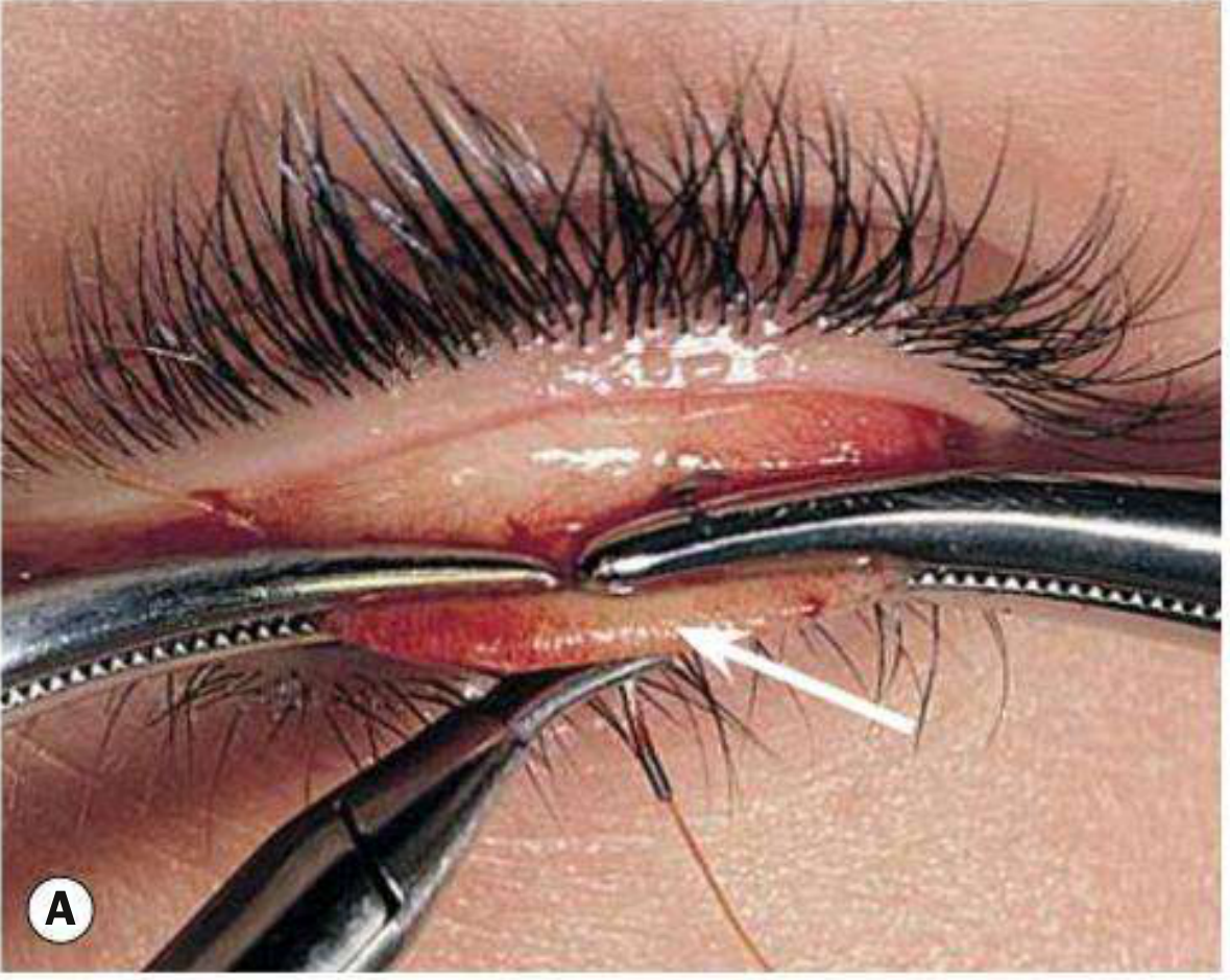 Pentagon excision surgical technique - eyelid margin held with instruments during reconstruction