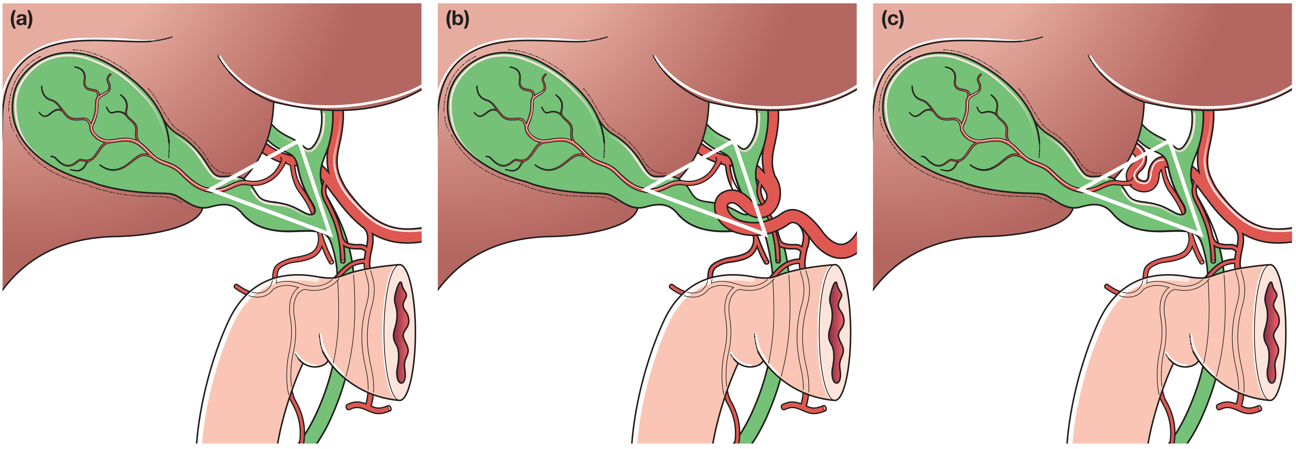 Hepatocystic triangle with variants: normal (a), caterpillar turn (b), tortuous right hepatic artery (c)