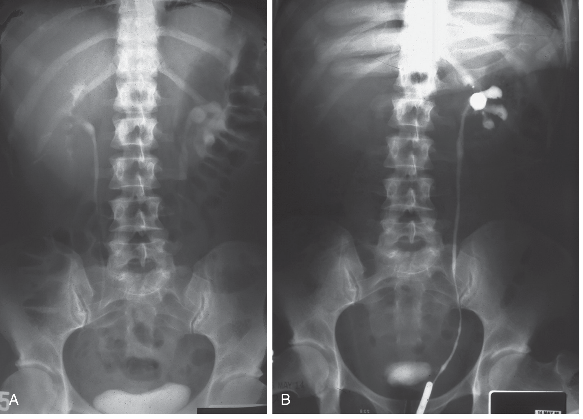 Renal TB - IVP showing unilateral hydronephrosis and calyceal distention with distal ureteric narrowing