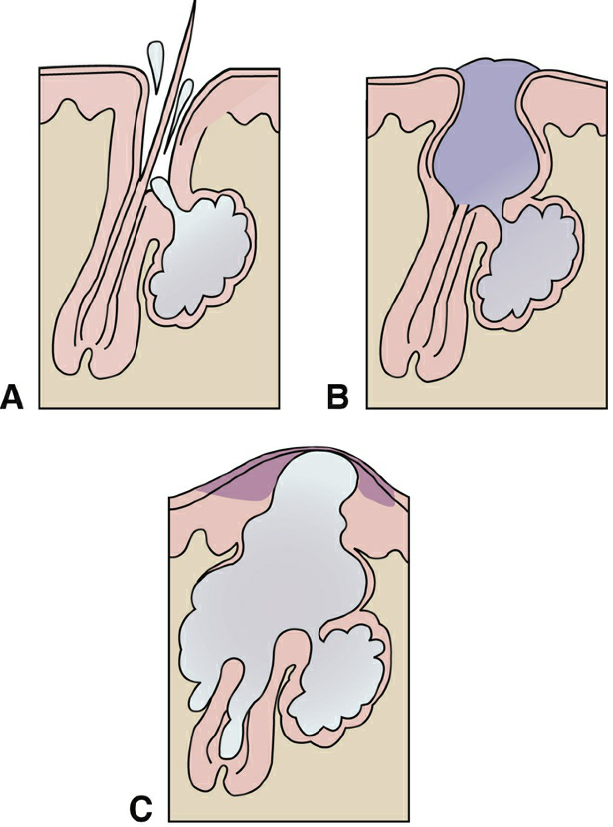 Acne vulgaris - A: Normal sebaceous gland and hair follicle. B: Comedone formation. C: Pustule formation.
