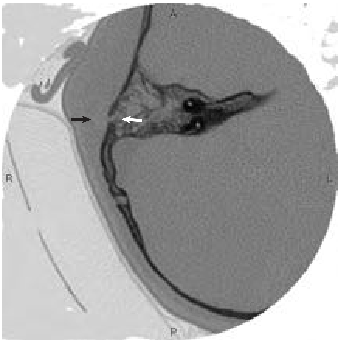 Axial CT scan showing mastoiditis with cortical bone defect (white arrow) and postauricular swelling/fluid collection (black arrow)
