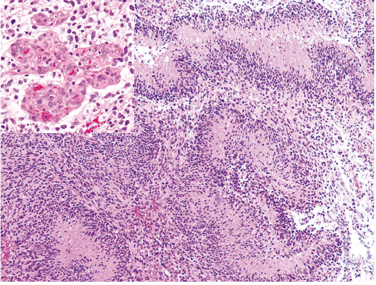 Glioblastoma IDH-wildtype H&E showing pseudopalisading necrosis and microvascular proliferation from Robbins textbook