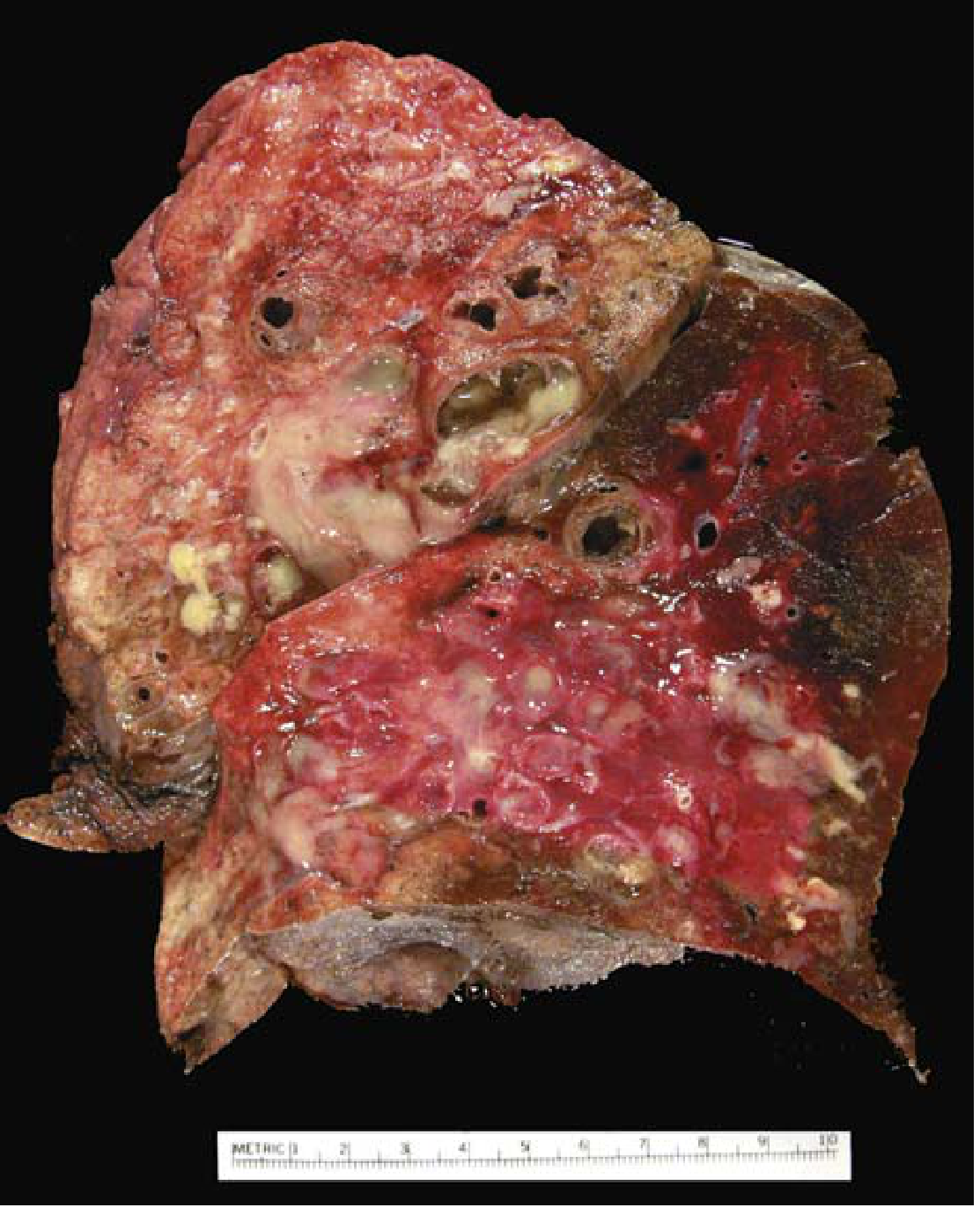 Gross specimen of bronchiectasis in cystic fibrosis - markedly dilated bronchi filled with purulent mucus extending to subpleural regions