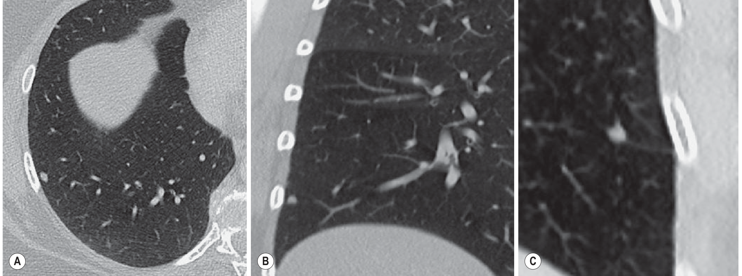 Intrapulmonary lymph node - perifissural nodule on CT