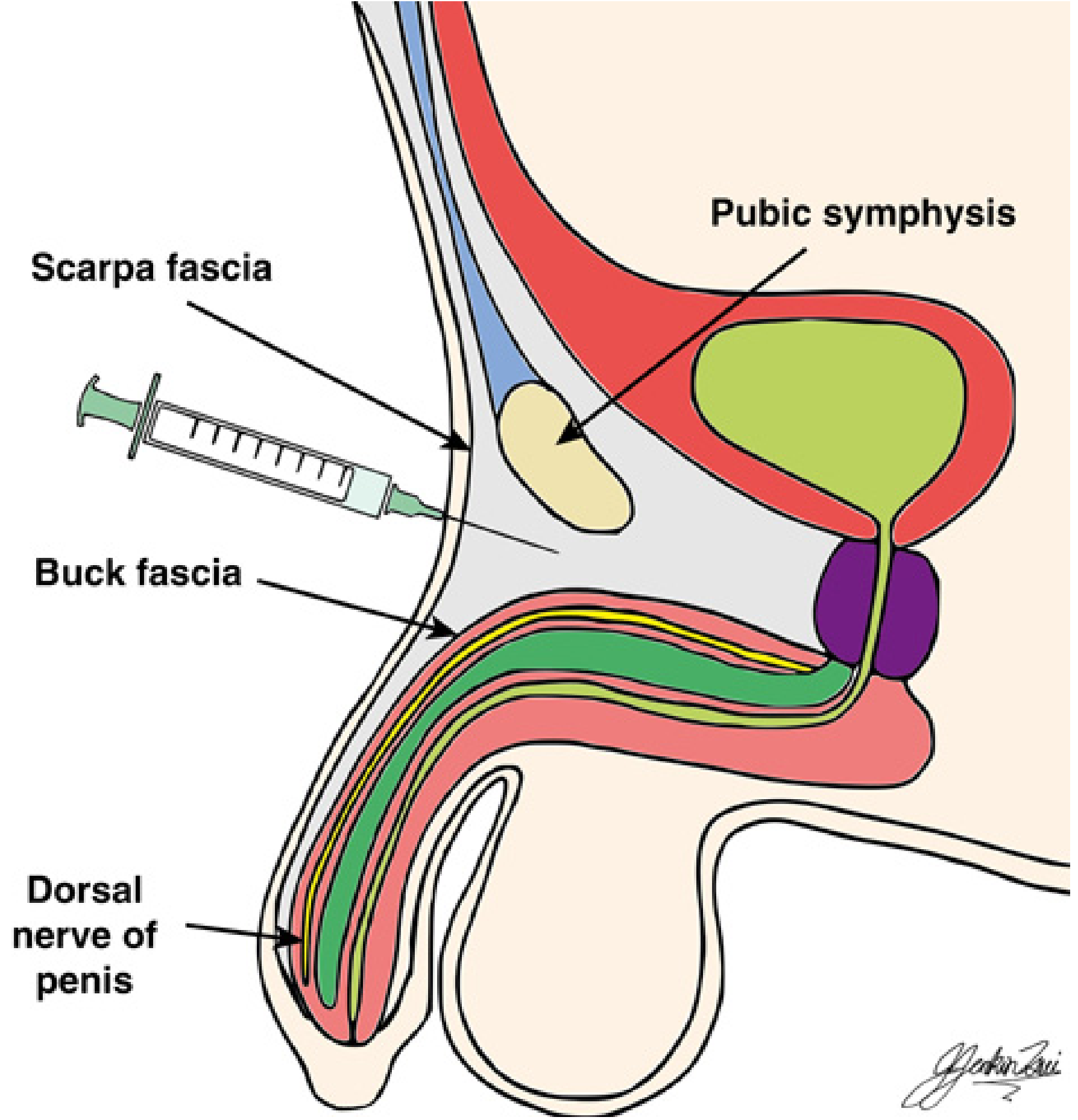 Penile block anatomy - subpubic approach showing Scarpa fascia, Buck fascia, and dorsal nerve of penis