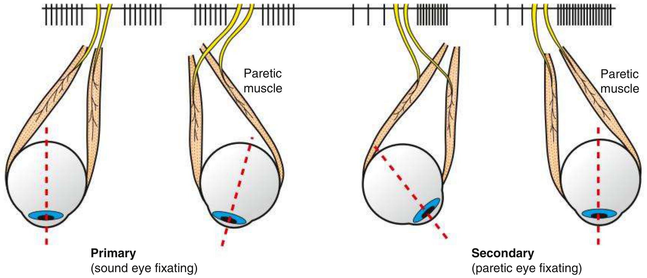 Primary and secondary deviation in paretic strabismus - when the sound eye fixates the deviation is smaller (primary); when the paretic eye fixates the deviation is larger (secondary) due to Hering's Law