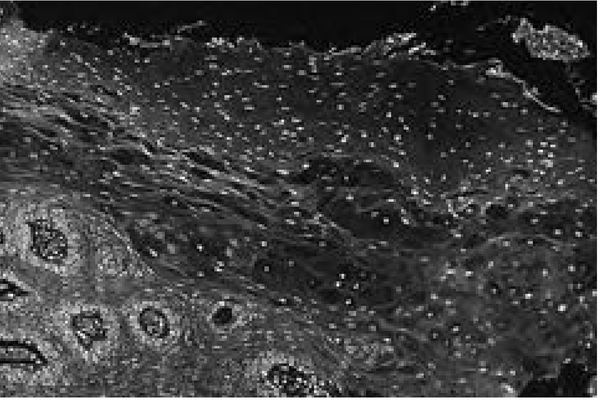 Hairy Leukoplakia histopathology - hyperparakeratosis and balloon cells in the upper spinous layer